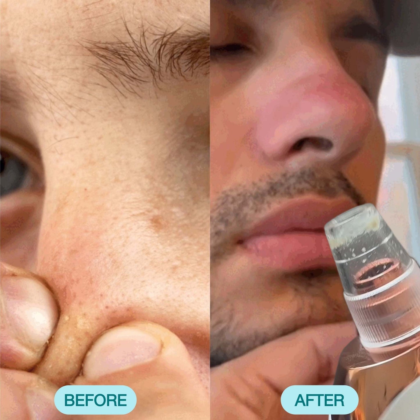 Nour Facial Pore Vacuum