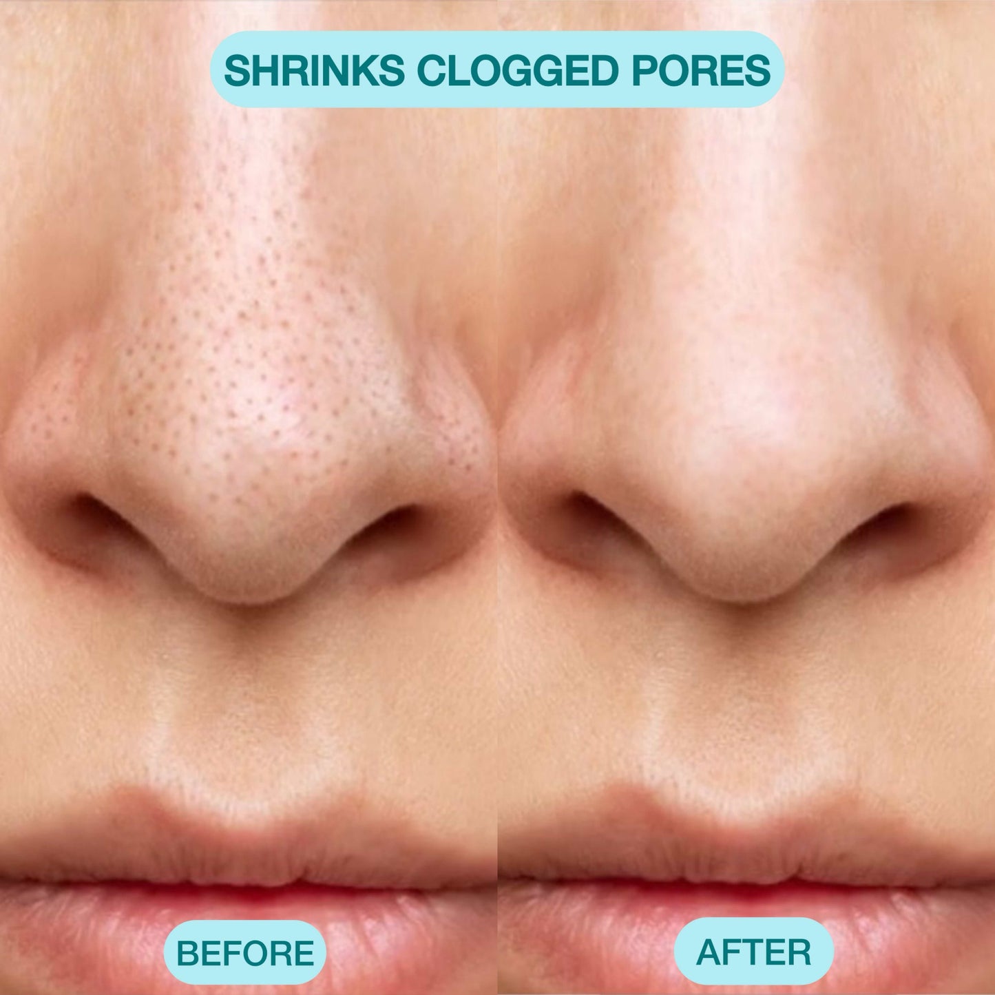 Nour Facial Pore Vacuum