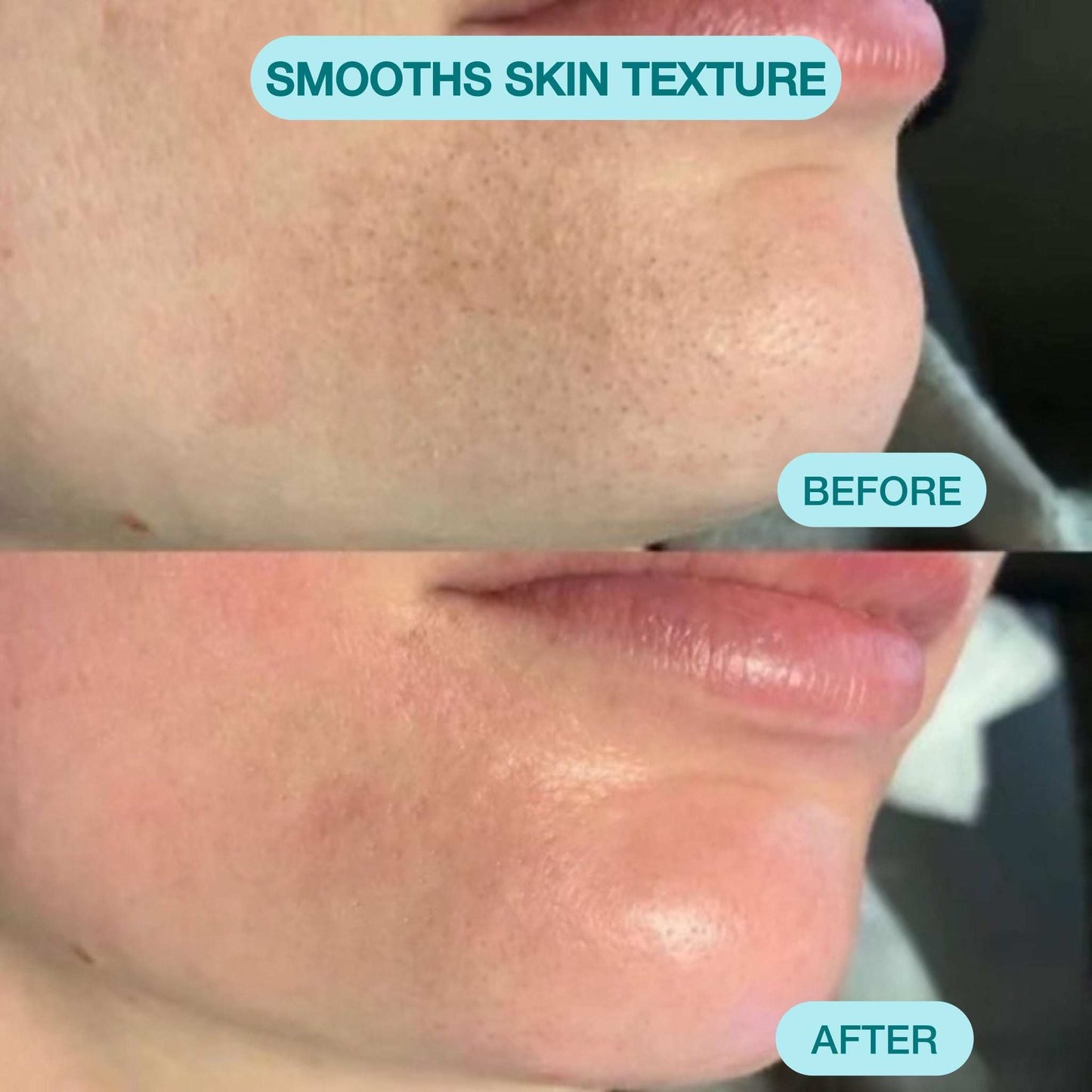 Nour Facial Pore Vacuum