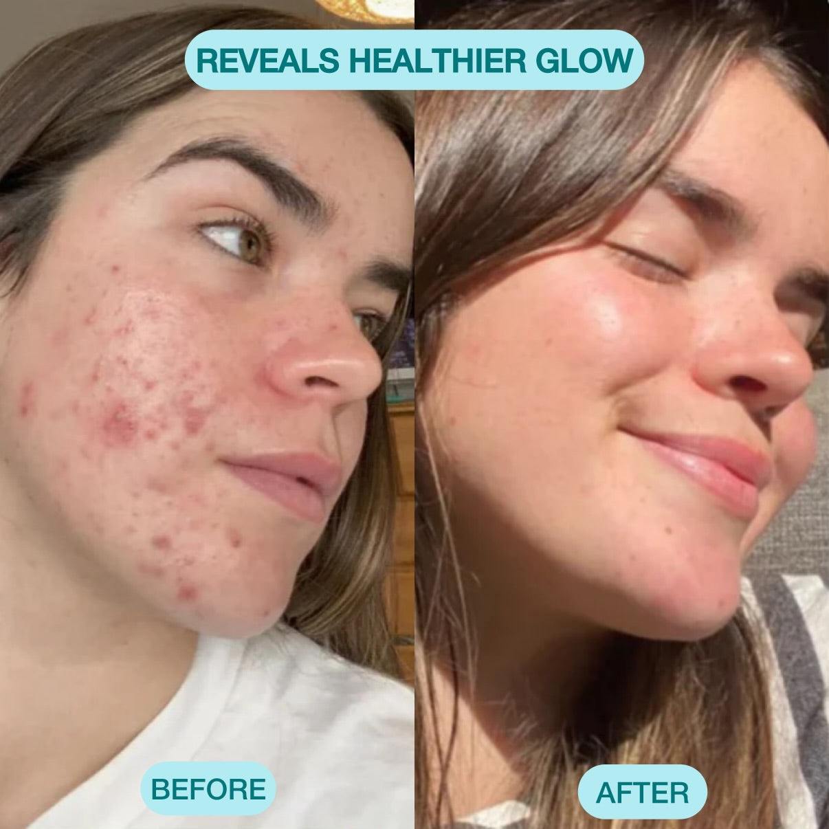 Nour Facial Pore Vacuum