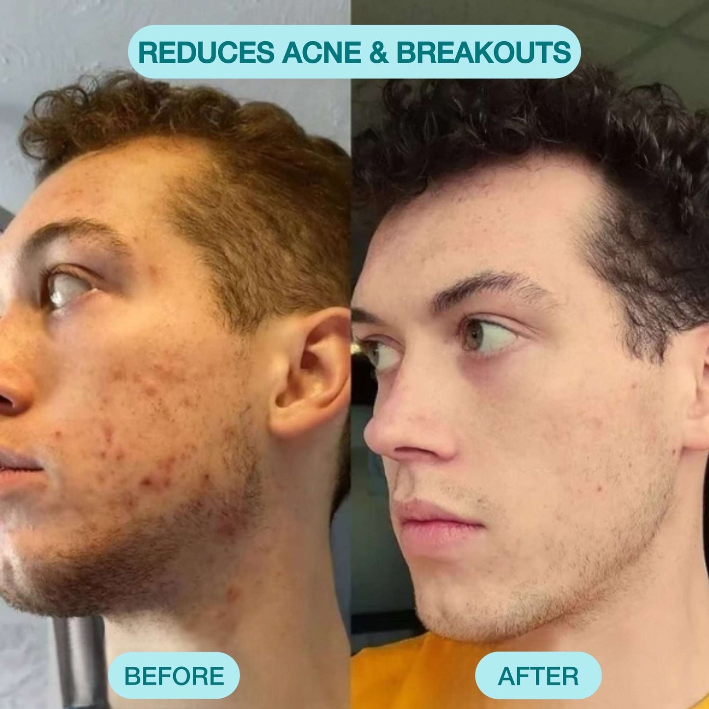 Nour Facial Pore Vacuum