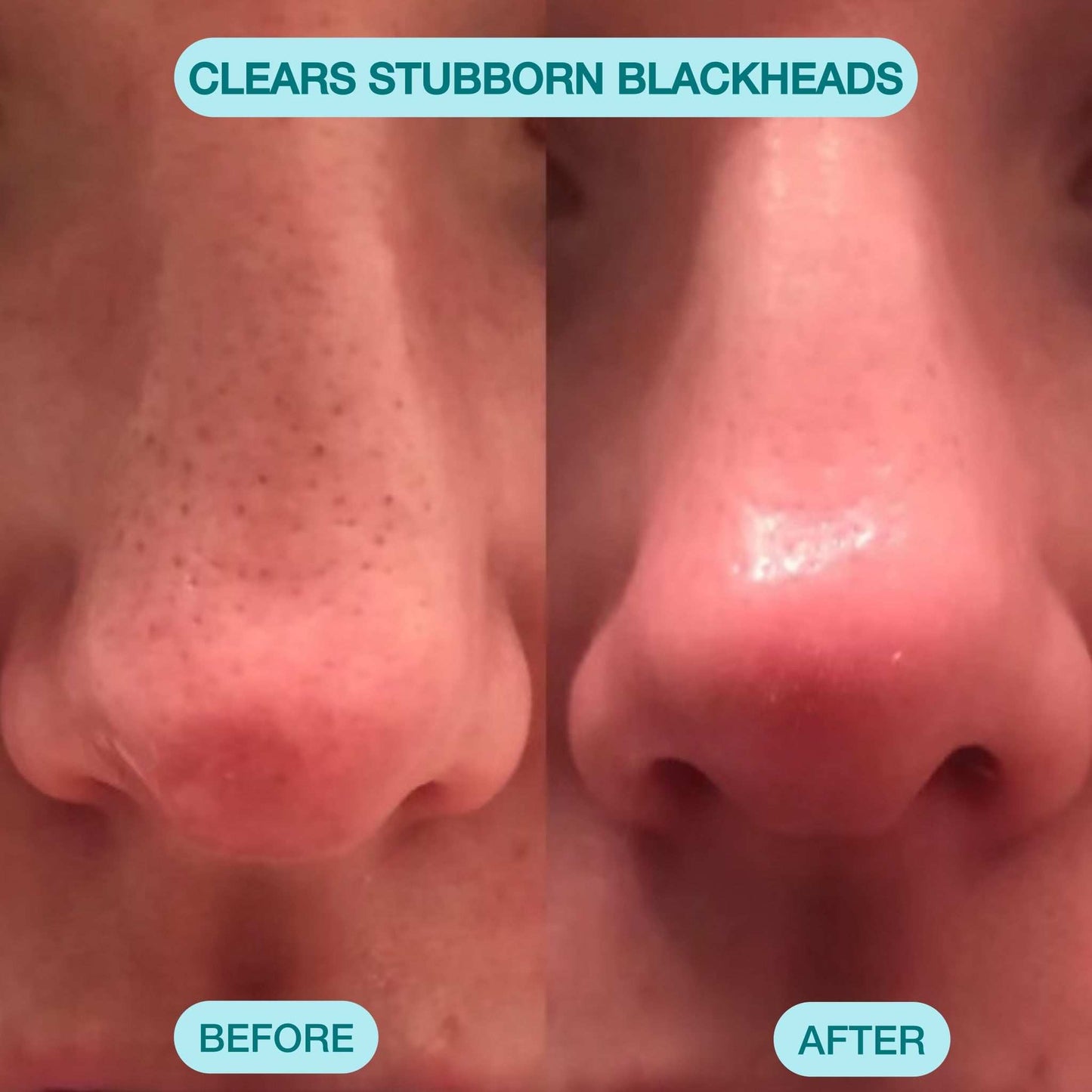 Nour Facial Pore Vacuum